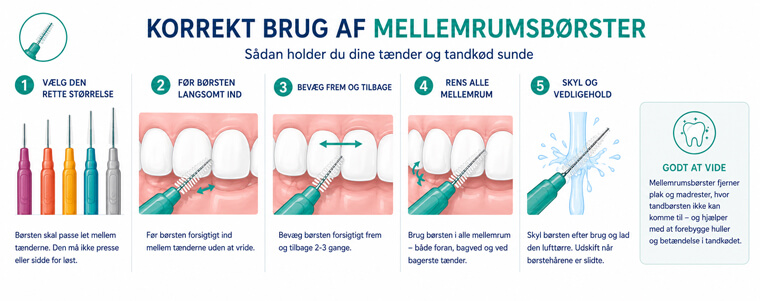 Illustration: korrekt brug af mellemrumsbørster i 5 trin