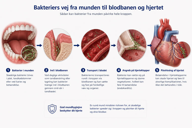 Illustration af bakteriers vej fra munden til blodbanen og hjertet i fem trin