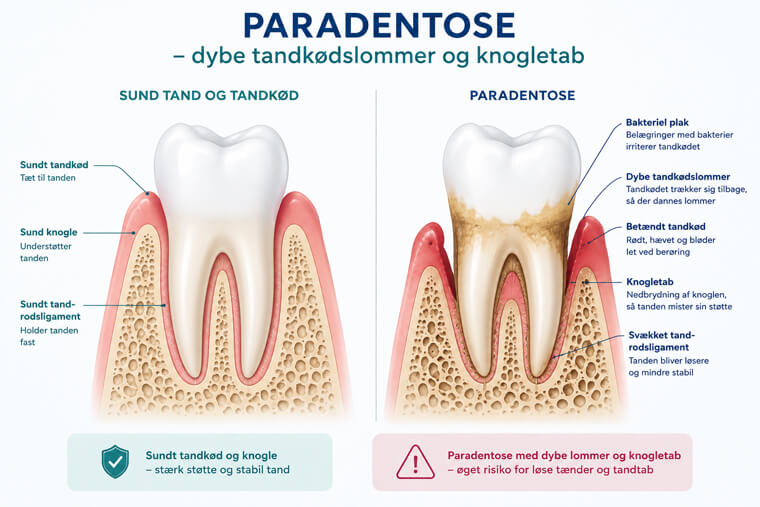 Illustration der sammenligner en sund tand og sundt tandkød med en tand ramt af paradentose, med dybe tandkødslommer og knogletab