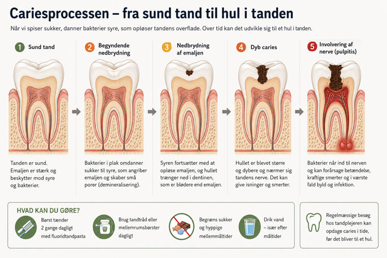 Illustration af cariesprocessen i fem trin, fra sund tand til dyb caries med involvering af nerven