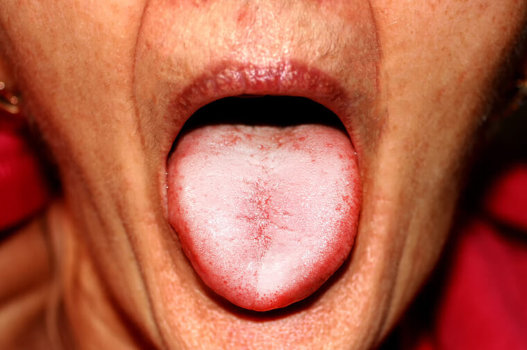 Mundsvamp (oral candidose) i mundhulen